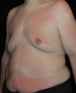 Male Body Contouring - Case 29 - Before