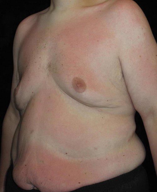 Male Body Contouring Patient Photo - Case 29 - before view-