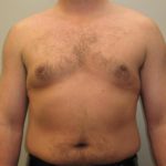 Male Breast Reduction - Case 23 - After