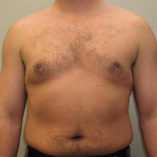 Male Breast Reduction Patient Photo - Case 23 - after view