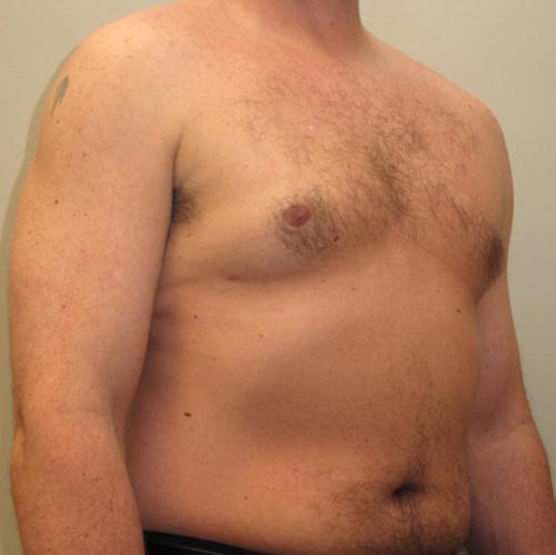 Male Breast Reduction Patient Photo - Case 23 - after view-1