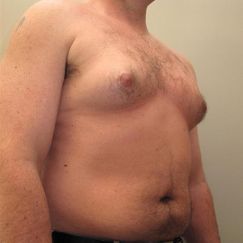 Male Breast Reduction Patient Photo - Case 23 - before view-1