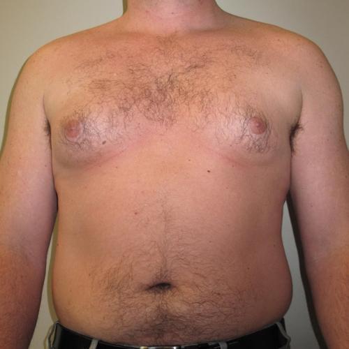 Male Breast Reduction Patient Photo - Case 23 - before view-