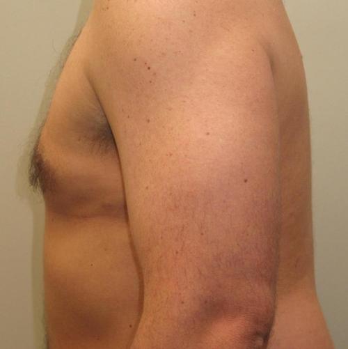 Male Breast Reduction Patient Photo - Case 23 - after view-2
