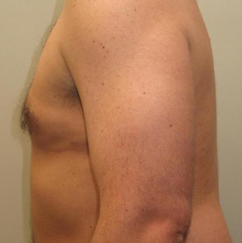 Male Breast Reduction Patient Photo - Case 23 - after view-2