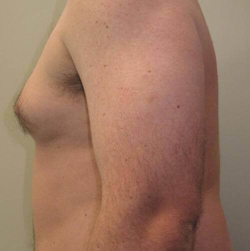Male Breast Reduction Patient Photo - Case 23 - before view-2