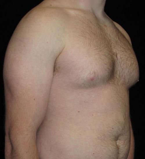 Male Breast Reduction Patient Photo - Case 28 - before view-1