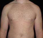 Male Breast Reduction - Case 28 - After