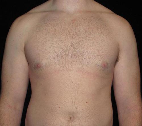 Male Breast Reduction Patient Photo - Case 28 - after view