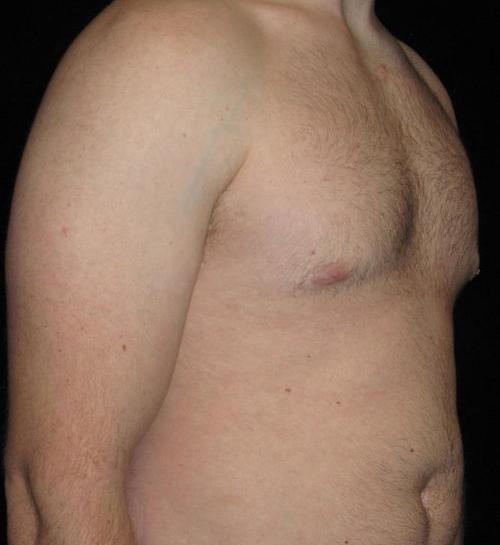 Male Breast Reduction Patient Photo - Case 28 - after view-1