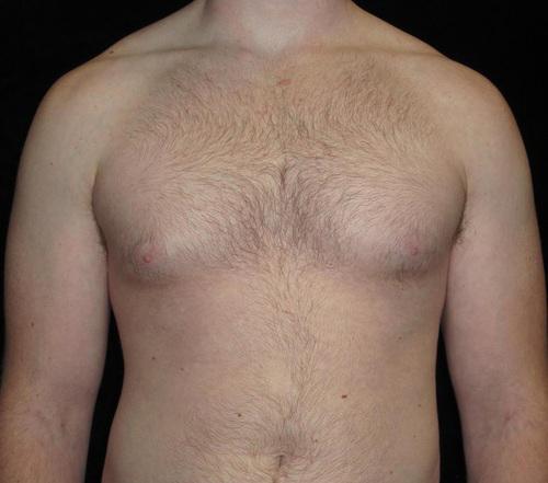 Male Breast Reduction Patient Photo - Case 28 - before view-0