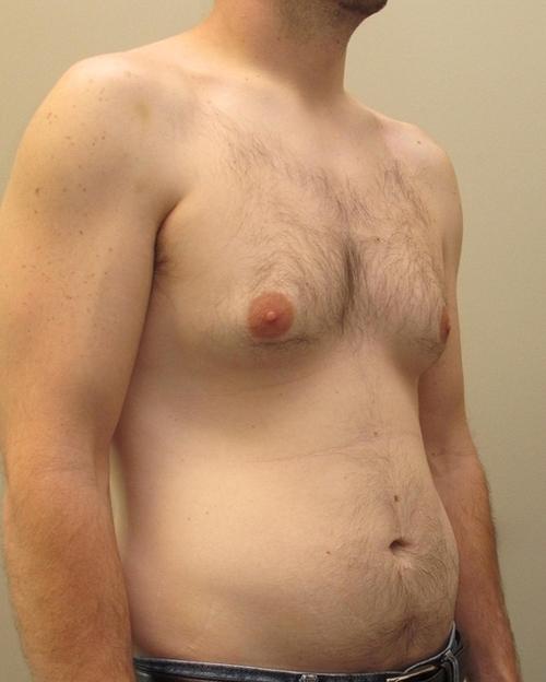 Male Breast Reduction Patient Photo - Case 22 - before view-1