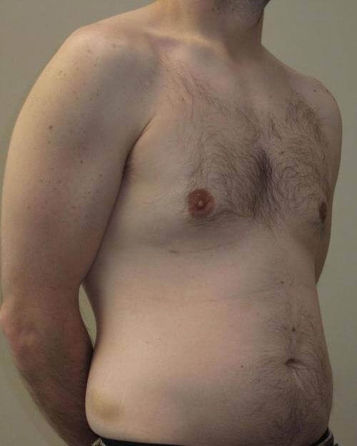 Male Breast Reduction Patient Photo - Case 22 - after view-1