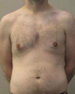 Male Breast Reduction - Case 22 - After