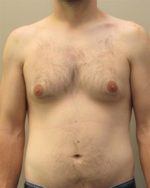 Male Breast Reduction - Case 22 - Before