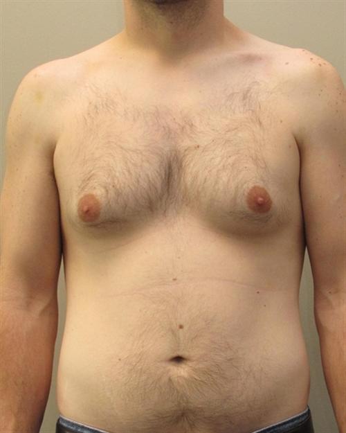 Male Breast Reduction Patient Photo - Case 22 - before view-0