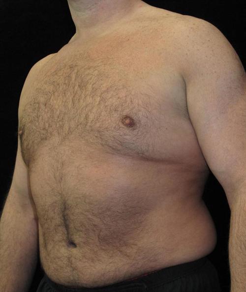 Male Breast Reduction Patient Photo - Case 26 - after view-1