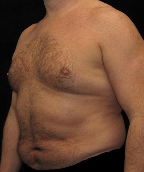 Male Breast Reduction Patient Photo - Case 26 - before view-1