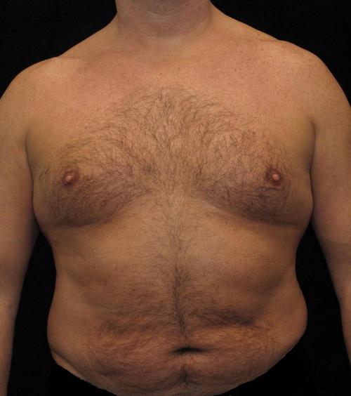 Male Breast Reduction Patient Photo - Case 26 - before view-