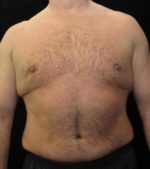 Male Breast Reduction - Case 26 - After