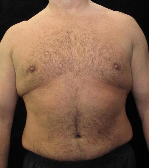 Male Breast Reduction Patient Photo - Case 26 - after view