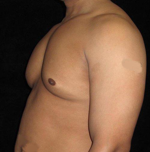 Male Breast Reduction Patient Photo - Case 30 - after view-1