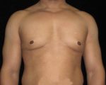 Male Breast Reduction - Case 30 - After