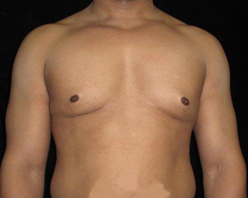 Male Breast Reduction Patient Photo - Case 30 - after view-0