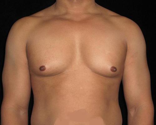 Male Breast Reduction Patient Photo - Case 30 - before view-