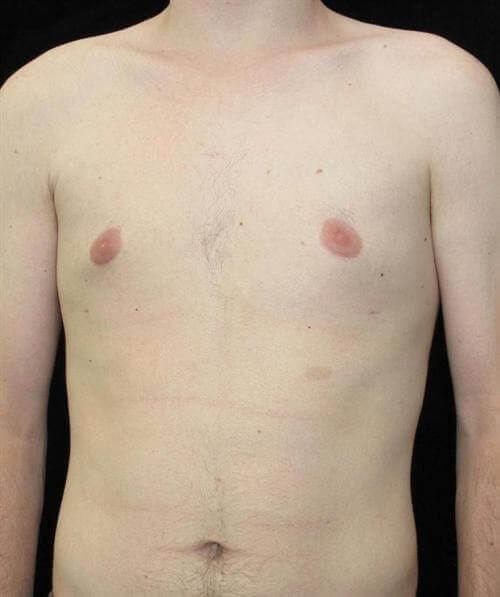 Male Breast Reduction Patient Photo - Case 25 - after view-0