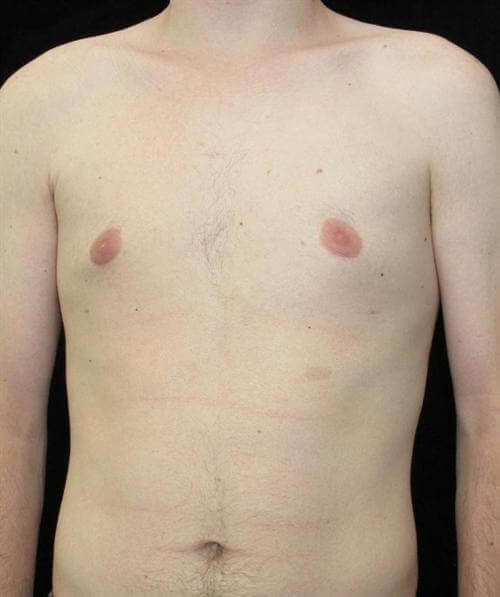 Male Breast Reduction Patient Photo - Case 25 - after view