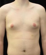 Male Breast Reduction - Case 25 - Before