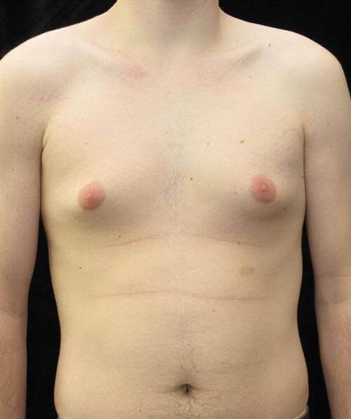 Male Breast Reduction Patient Photo - Case 25 - before view-