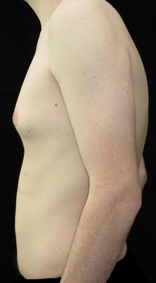 Male Breast Reduction Patient Photo - Case 25 - before view-1