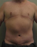 Male Body Contouring - Case 24 - After