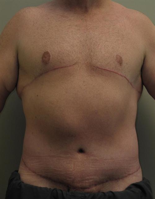 Male Body Contouring Patient Photo - Case 24 - after view