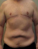 Male Body Contouring - Case 24 - Before