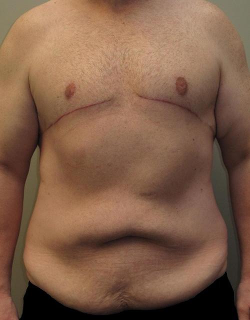 Male Body Contouring Patient Photo - Case 24 - before view-
