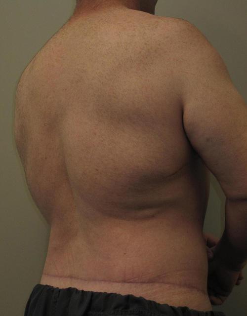 Male Body Contouring Patient Photo - Case 24 - after view-1