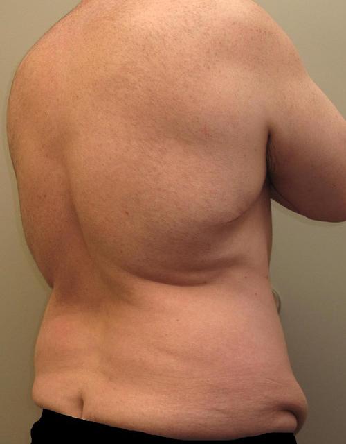 Male Body Contouring Patient Photo - Case 24 - before view-1