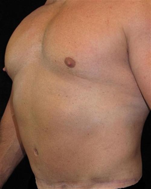 Male Body Contouring Patient Photo - Case 21 - after view-1