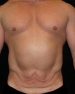 Male Body Contouring - Case 21 - Before