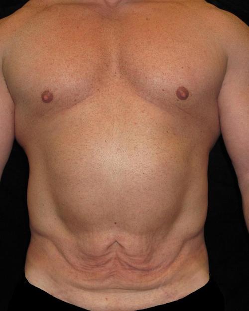 Male Body Contouring Patient Photo - Case 21 - before view-