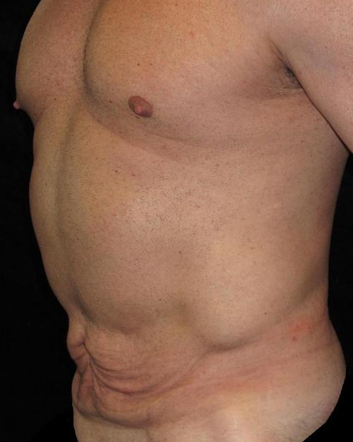 Male Body Contouring Patient Photo - Case 21 - before view-1