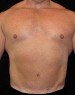 Male Body Contouring - Case 21 - After