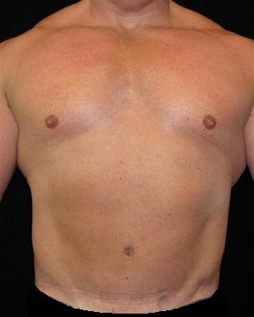 Male Body Contouring Patient Photo - Case 21 - after view