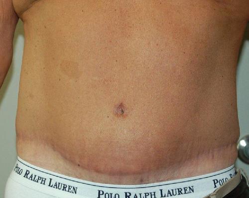 Male Body Contouring Patient Photo - Case 20 - after view-0