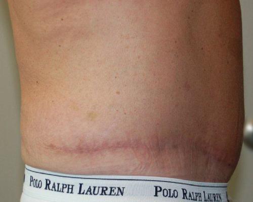 Male Body Contouring Patient Photo - Case 20 - after view-1