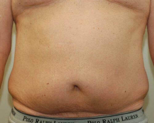 Male Body Contouring Patient Photo - Case 20 - before view-0