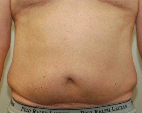 Male Body Contouring Patient Photo - Case 20 - before view-